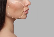 เจอปัญหาผิวสู้ไม่ไหวอย่างเพิ่งท้อ