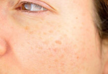 สาววัย 30 ต้องรู้ คอร์สรักษาฝ้า กระ จำเป็นไหม