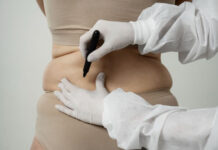 การดูดไขมัน (Liposuction) คืออะไร พร้อมข้อควรรู้ก่อนตัดสินใจ