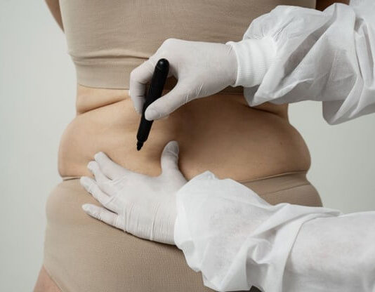 การดูดไขมัน (Liposuction) คืออะไร พร้อมข้อควรรู้ก่อนตัดสินใจ