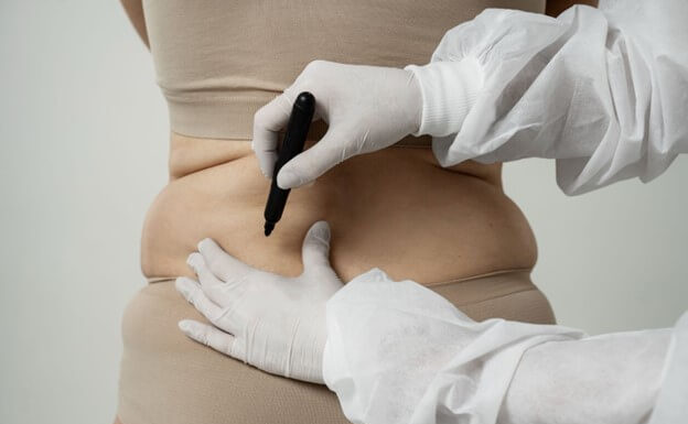 การดูดไขมัน (Liposuction) คืออะไร พร้อมข้อควรรู้ก่อนตัดสินใจ