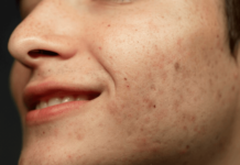 5 ปัจจัยสำคัญที่ต้องพิจารณาในการเลือกคลินิกรักษาหลุมสิว