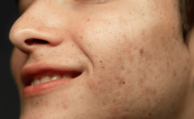 5 ปัจจัยสำคัญที่ต้องพิจารณาในการเลือกคลินิกรักษาหลุมสิว