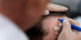 คลินิกปลูกผม FUE