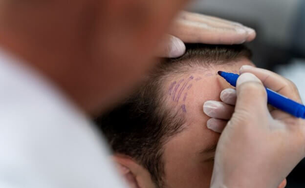 คลินิกปลูกผม FUE