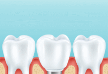 ทันตกรรมรากฟันเทียม เชียงใหม่